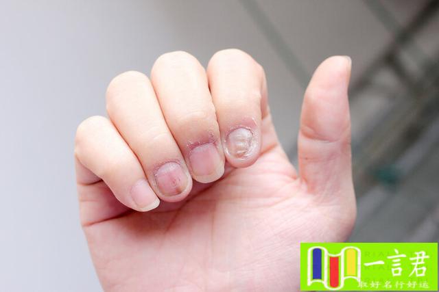 女生左手食指长了一颗痣代表什么意思（体内有癌，手指先知？提醒手部若有3个异常，或是癌症“预警”）