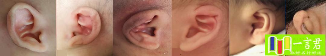 耳朵形状有几种图片（为什么我家宝宝的耳朵这么丑？专家耳廓形态畸形，治疗不要错过“黄金时间”）